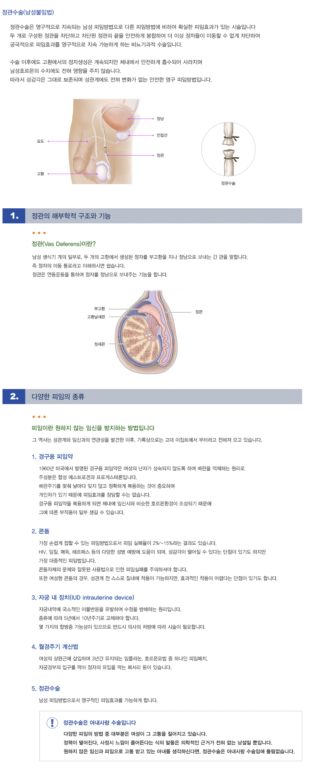 GM정관수술